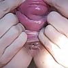 25P A prolapsed vagina...