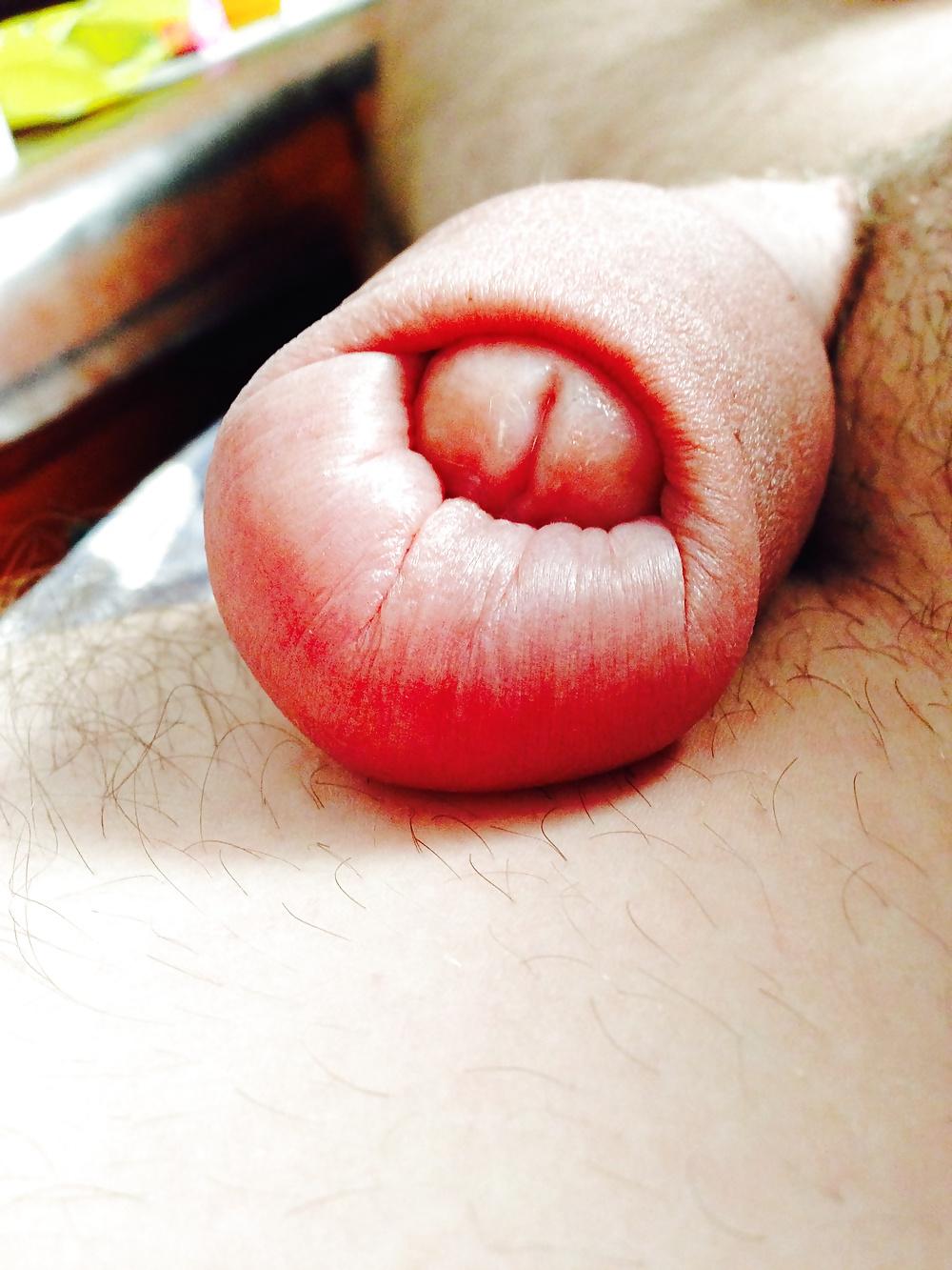 14P Huge swollen foreskin brutal pump severe bruising 