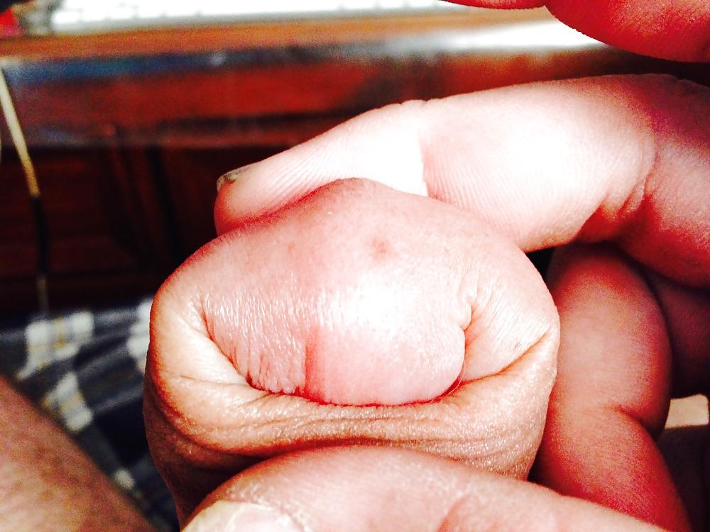 14P Huge swollen foreskin brutal pump severe bruising 