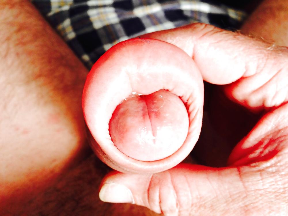 14P Huge swollen foreskin brutal pump severe bruising 