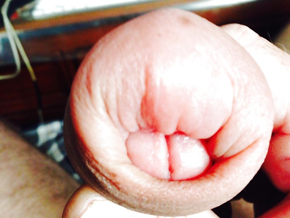 14P Huge swollen foreskin brutal pump severe bruising 