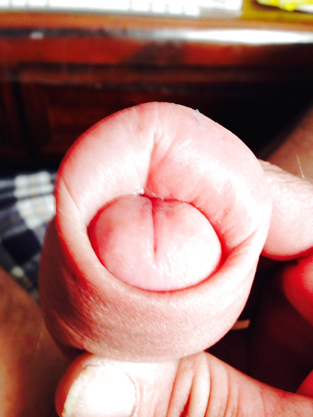 14P Huge swollen foreskin brutal pump severe bruising 
