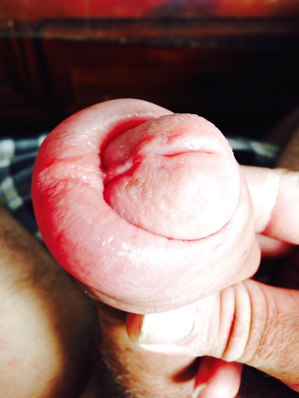 14P Huge swollen foreskin brutal pump severe bruising 