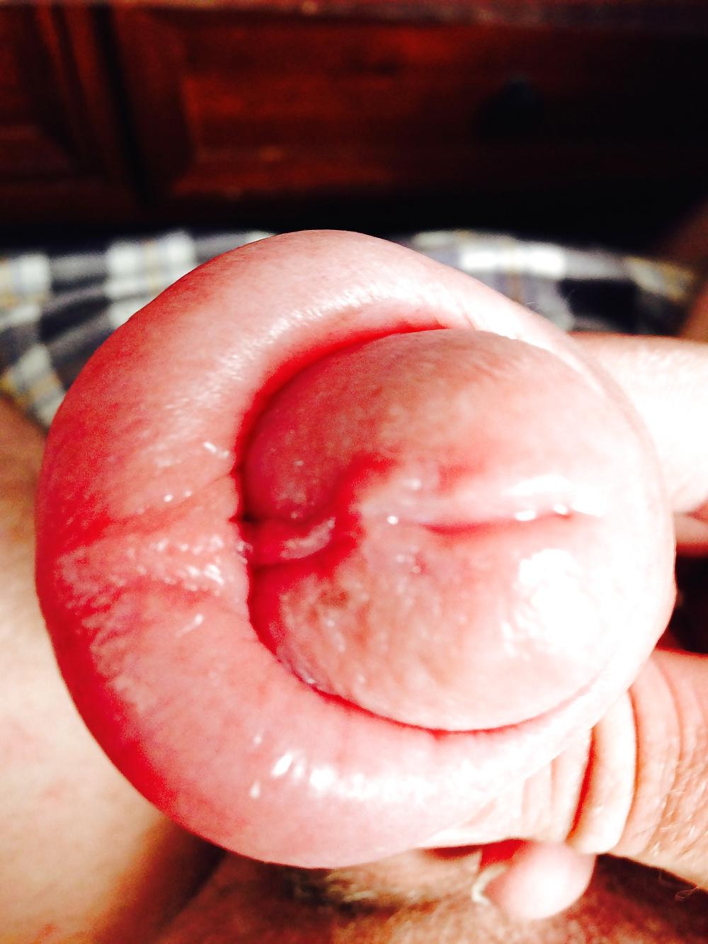 14P Huge swollen foreskin brutal pump severe bruising 
