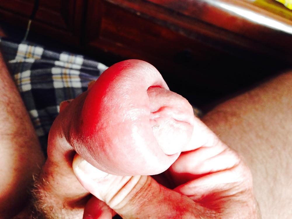 14P Huge swollen foreskin brutal pump severe bruising 