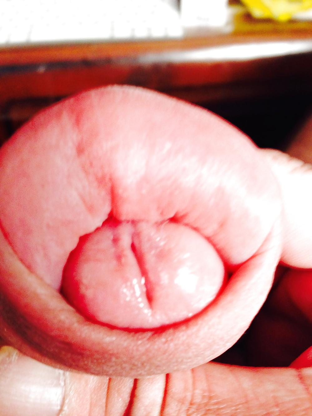14P Huge swollen foreskin brutal pump severe bruising 