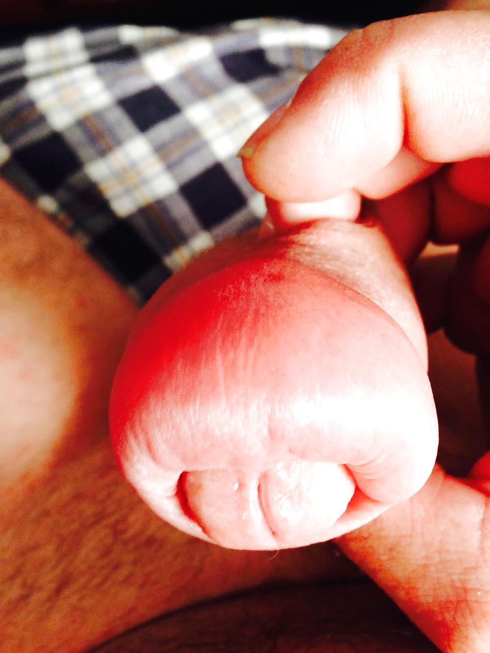 14P Huge swollen foreskin brutal pump severe bruising 