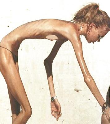 18P Anorexic Girls