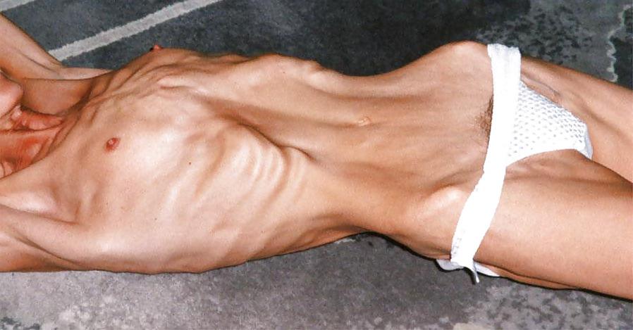 18P Anorexic Girls