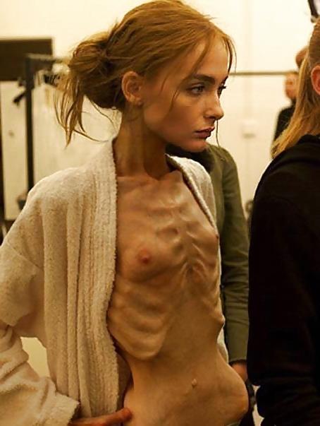 18P Anorexic Girls