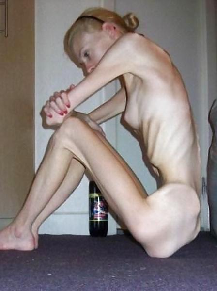 18P Anorexic Girls