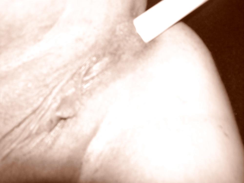 4P Candle anal