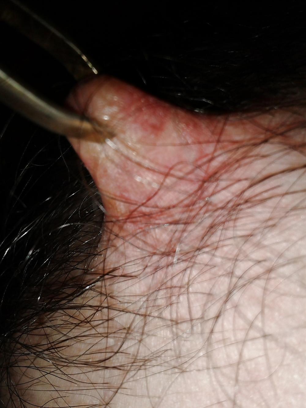 13P Examined male nipples