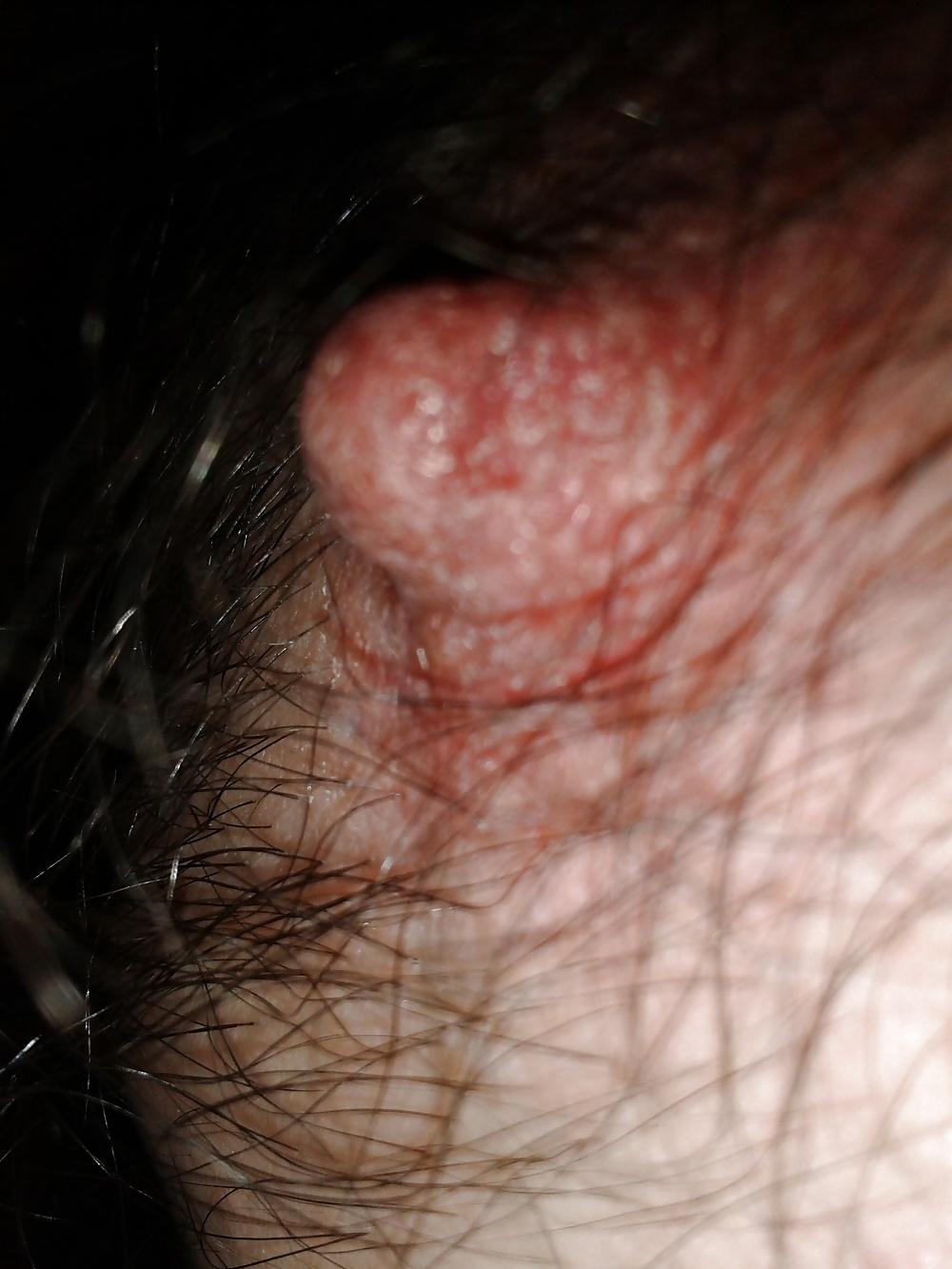 13P Examined male nipples