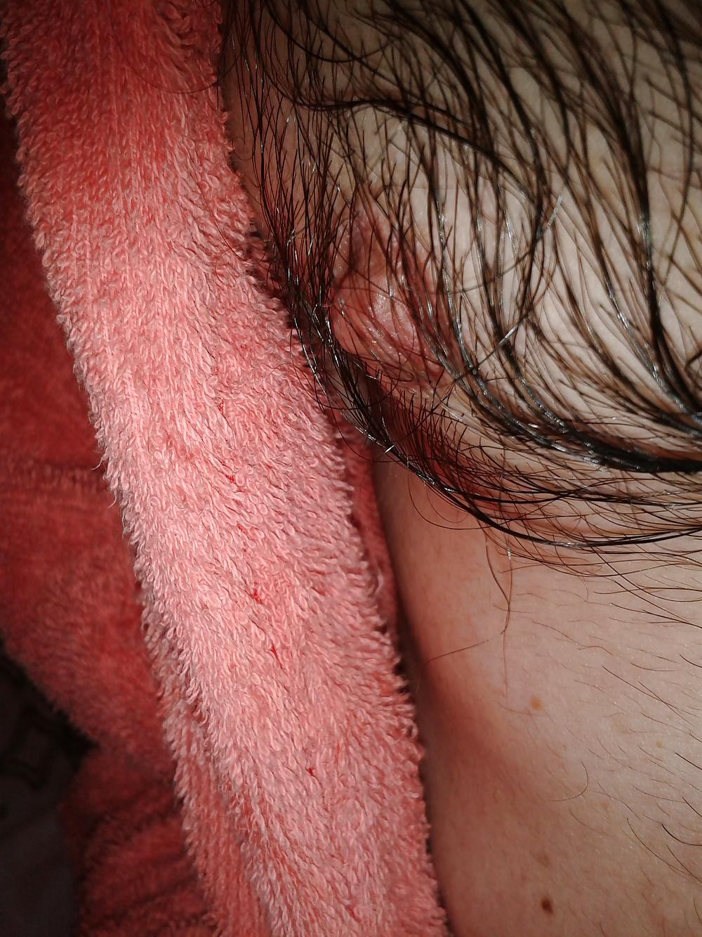 13P Examined male nipples