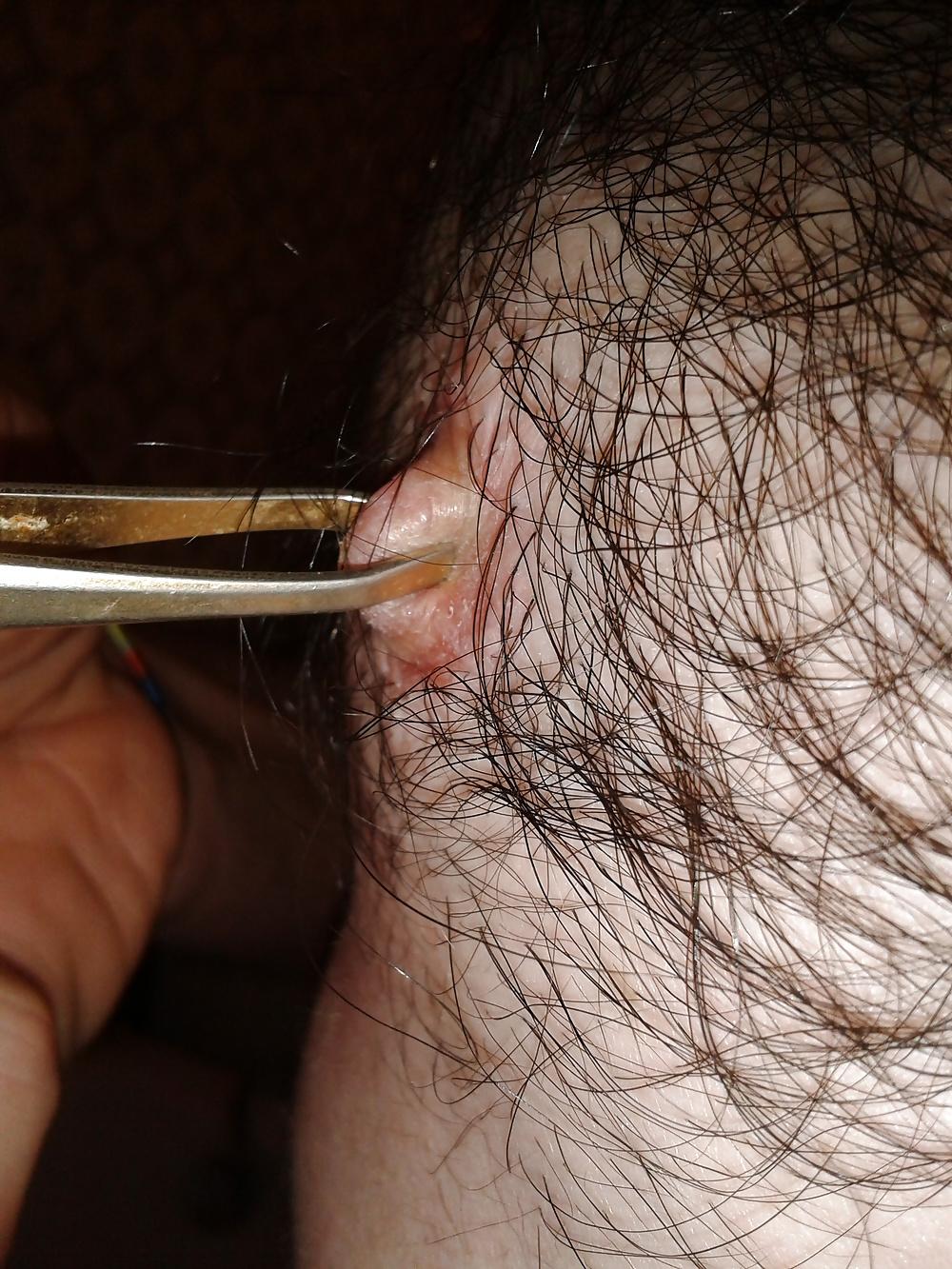 13P Examined male nipples