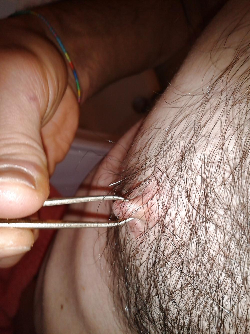 13P Examined male nipples