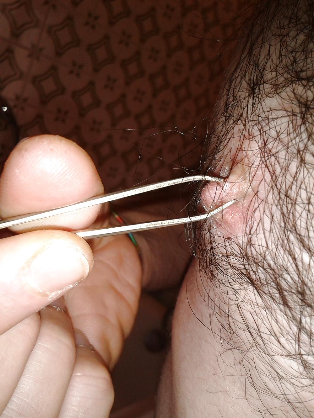 13P Examined male nipples