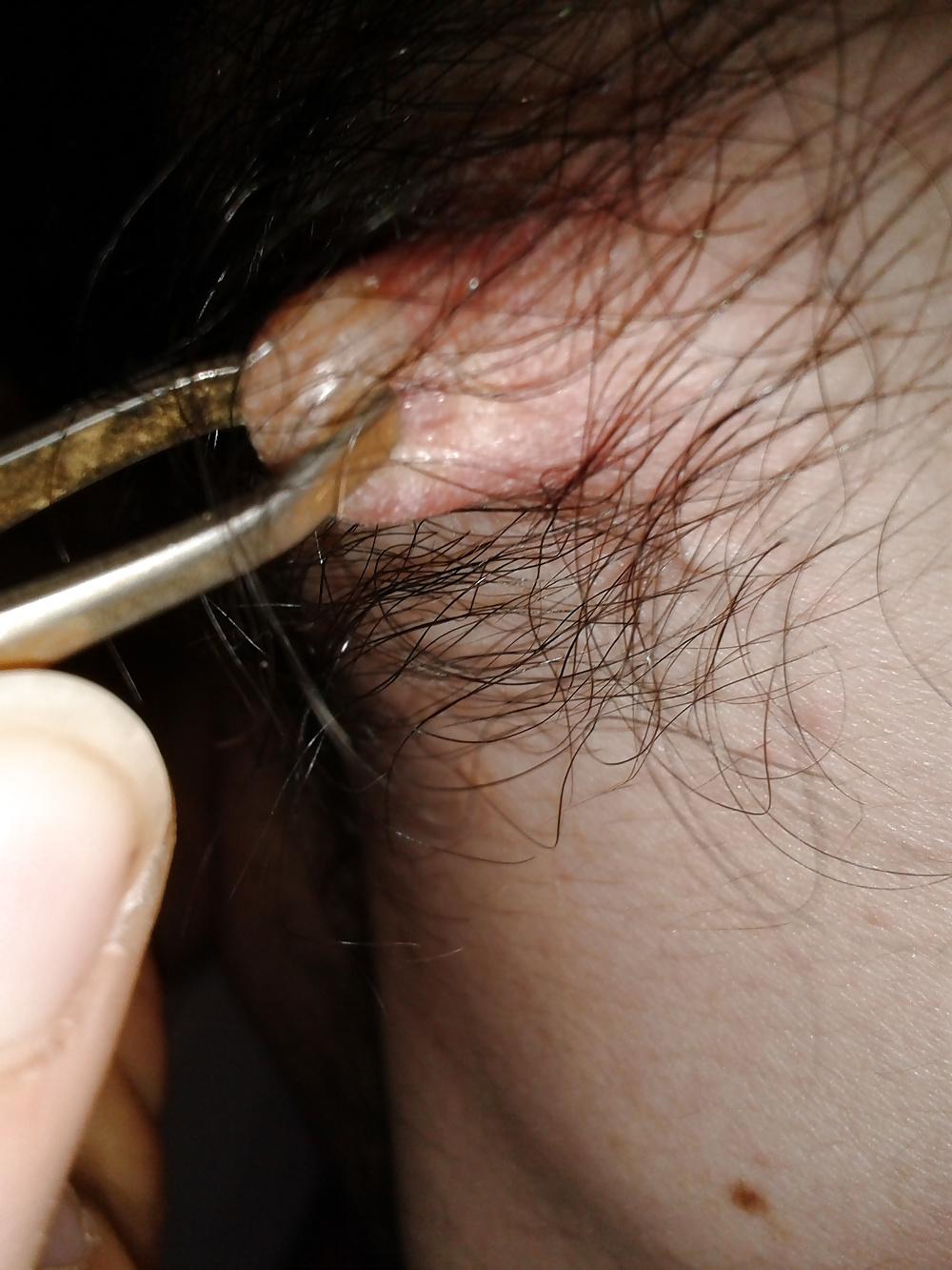 13P Examined male nipples