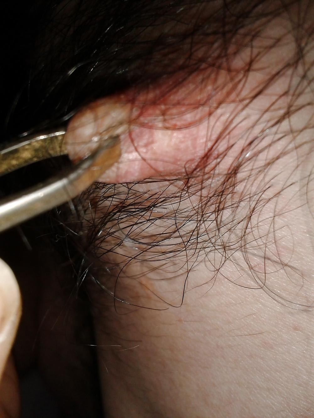 13P Examined male nipples