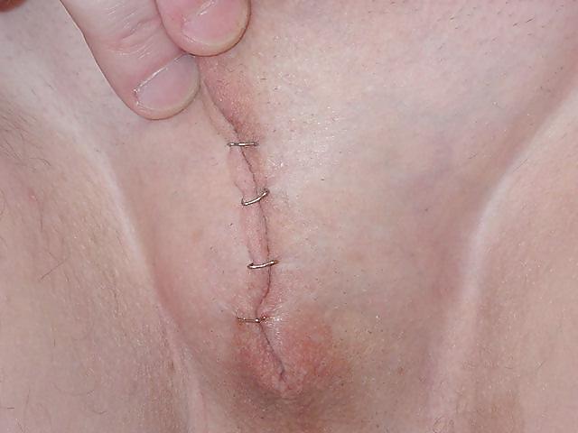 25P Temp Nullo - Sutures and Staples