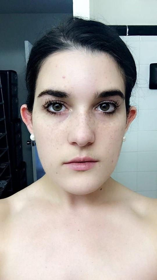 25P DNC operative with puffy Nipples