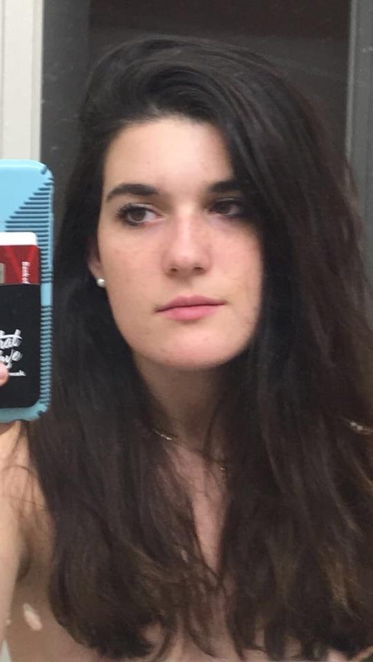 25P DNC operative with puffy Nipples