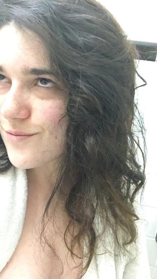 25P DNC operative with puffy Nipples