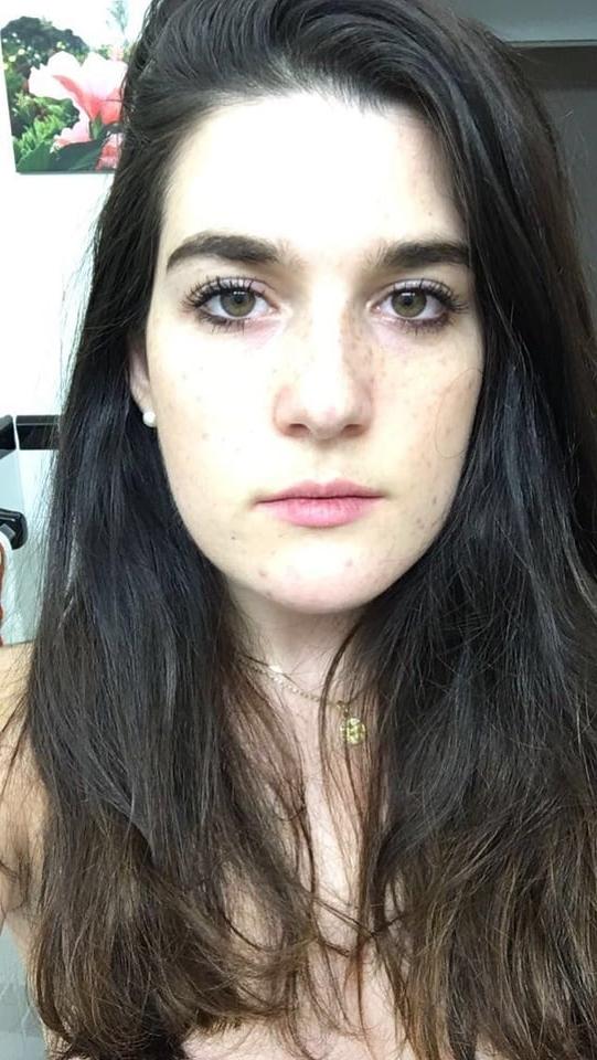 25P DNC operative with puffy Nipples