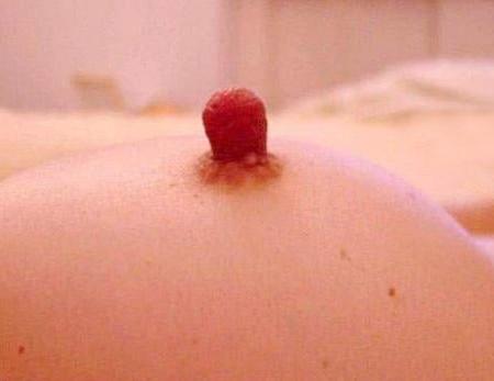 22P Puffy nipples