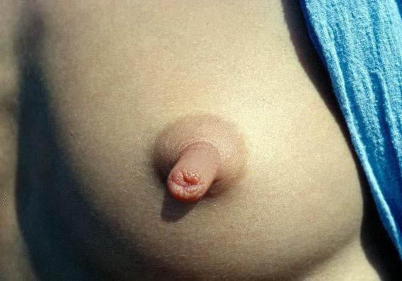 22P Puffy nipples