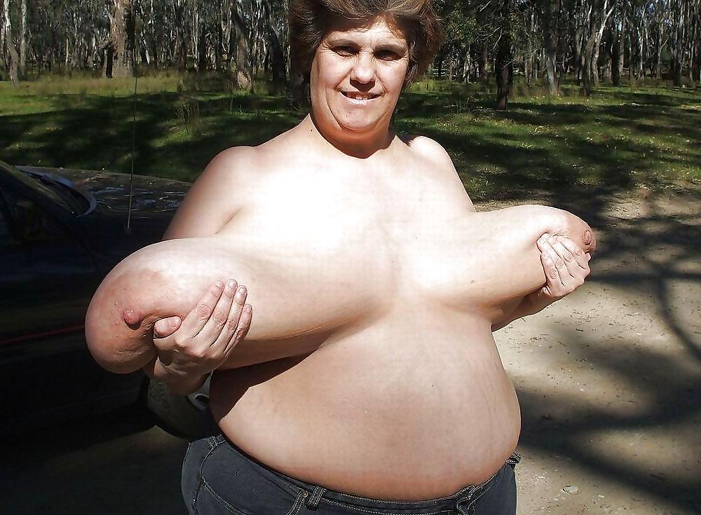 25P Stretch Marks, Scars and Saggy 15