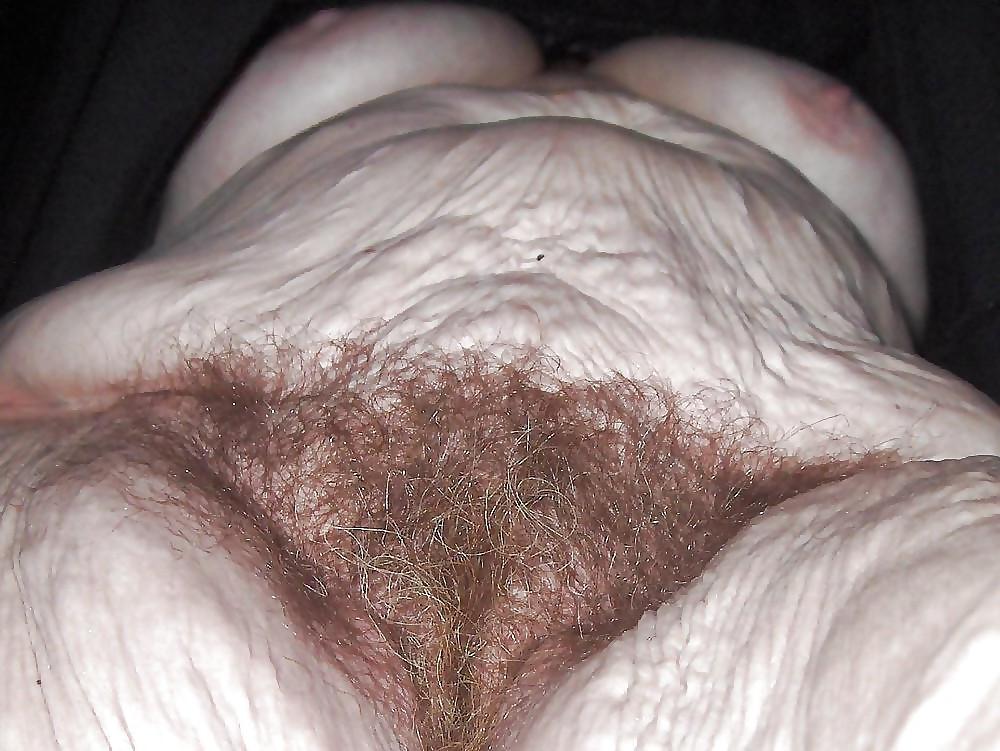 25P Stretch Marks, Scars and Saggy 15