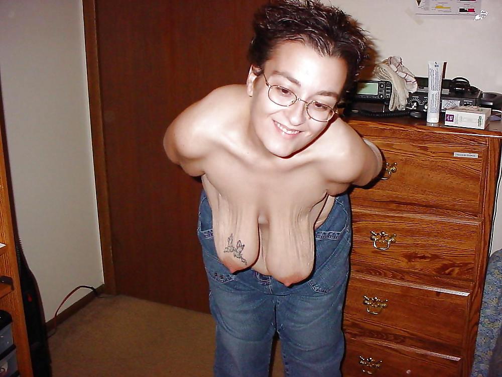 25P Stretch Marks, Scars and Saggy 12
