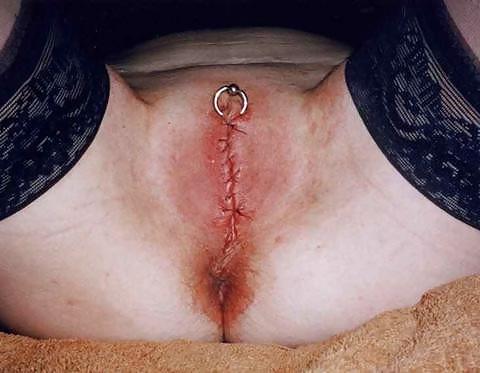 25P Female Infibulation