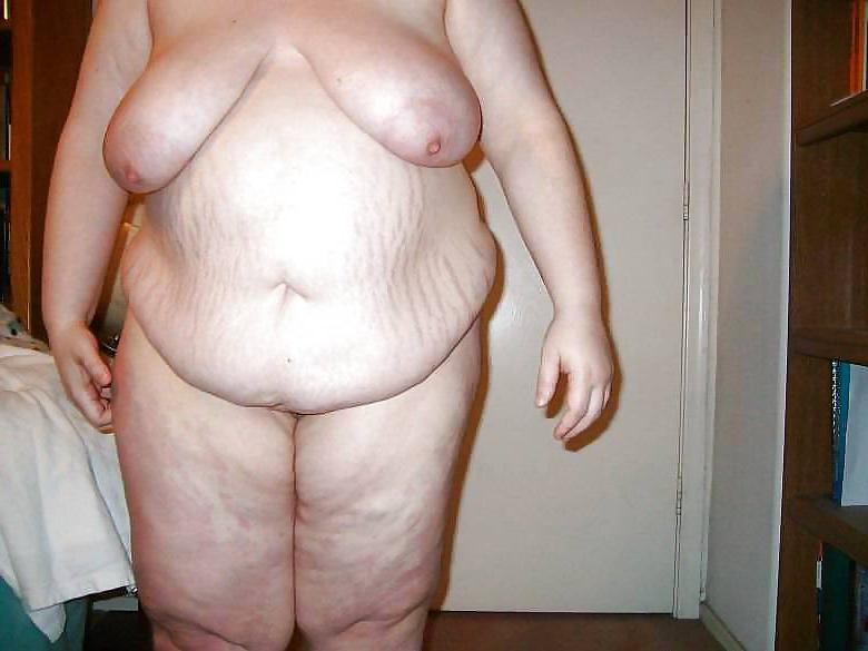 25P Stretch Marks, Scars and Saggy 10