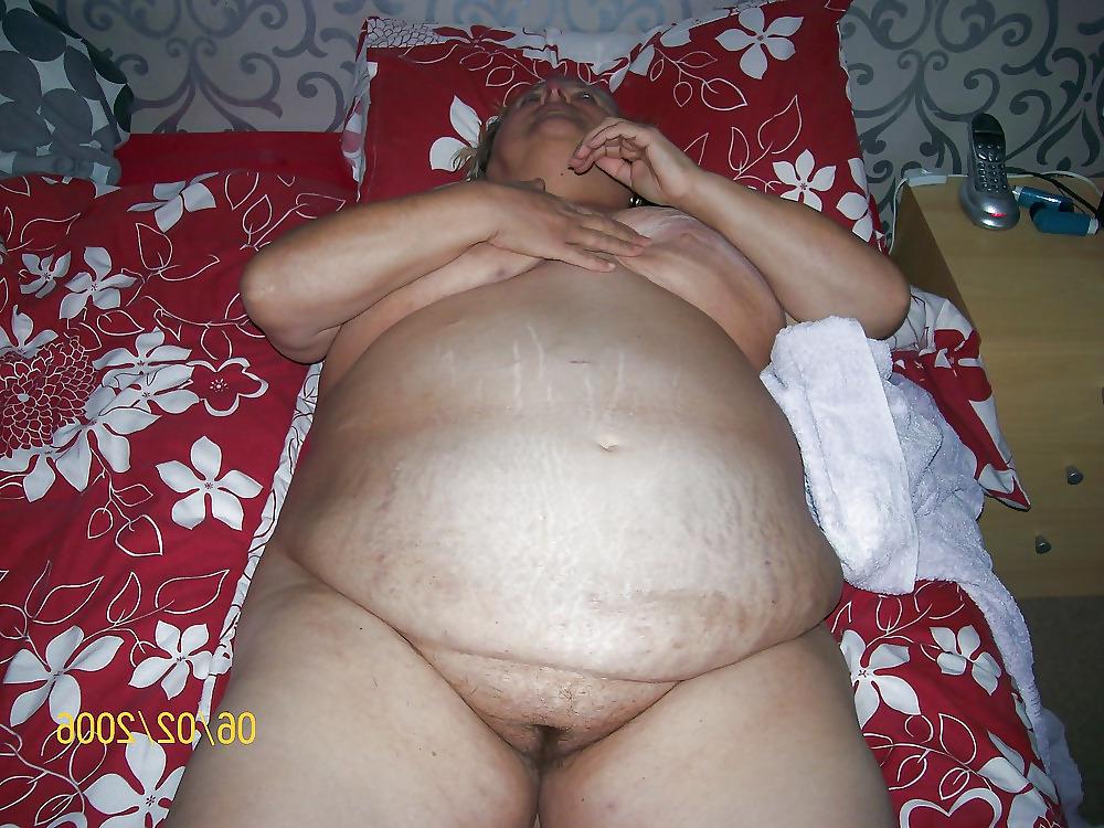 25P Stretch Marks, Scars and Saggy 24
