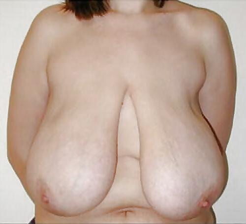 25P Stretch Marks, Scars and Saggy 24