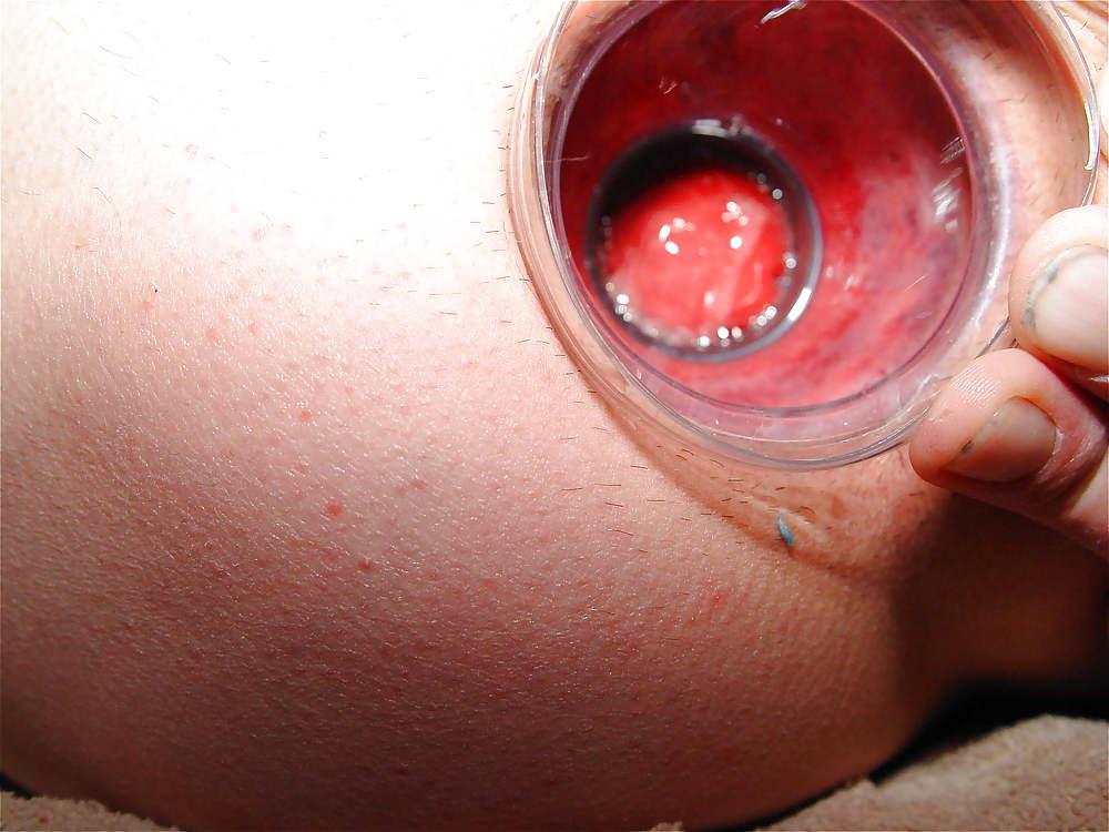 22P Gyno stretch
