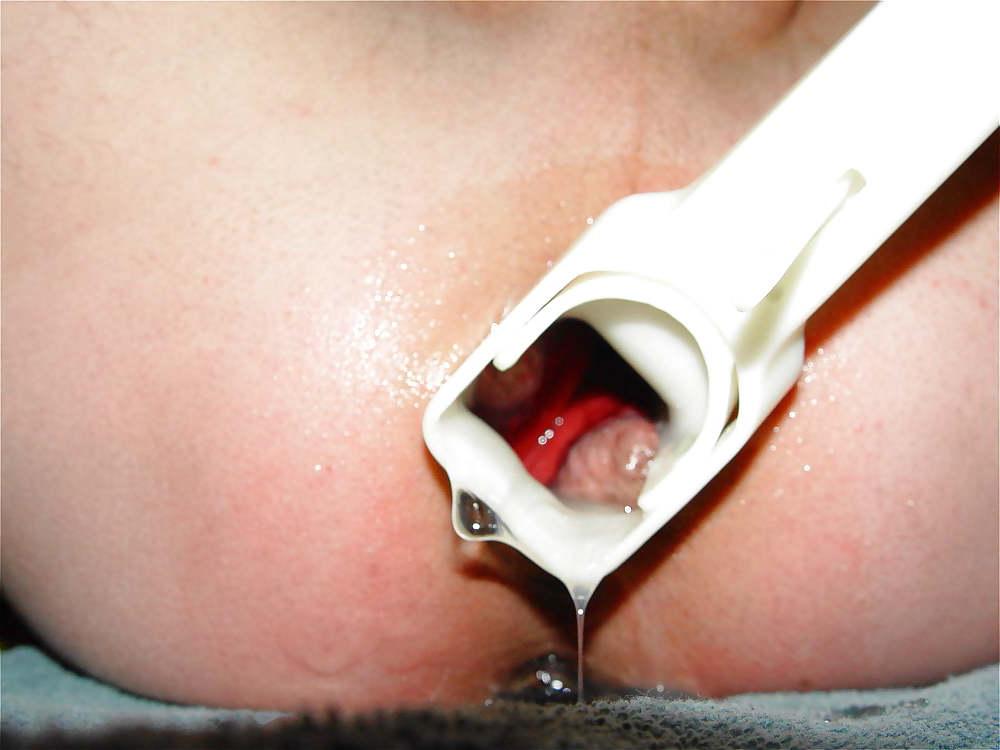 22P Gyno stretch