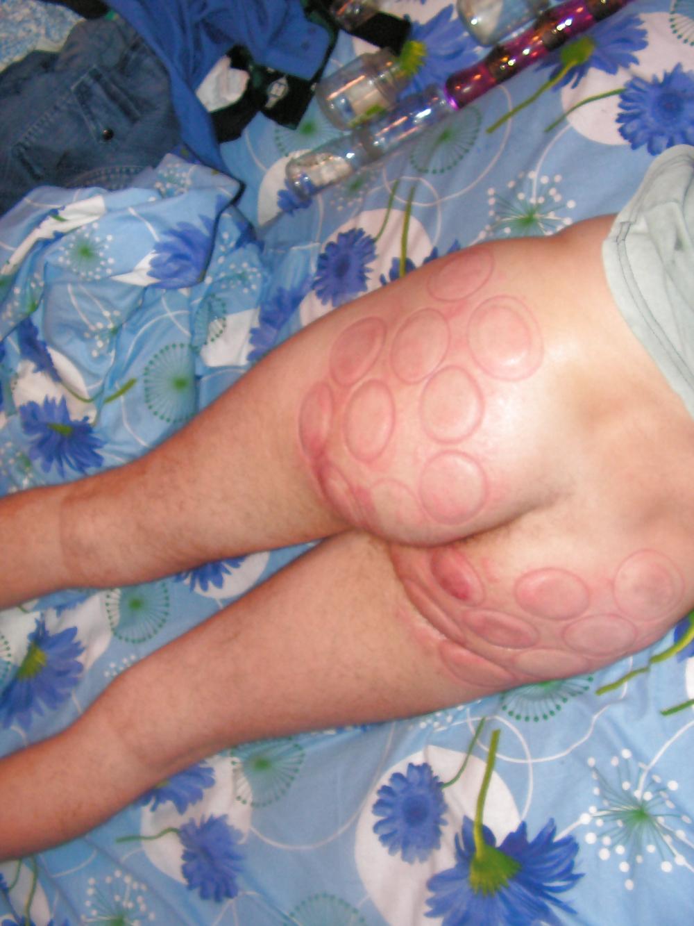 18P BDSM fire cups on ass