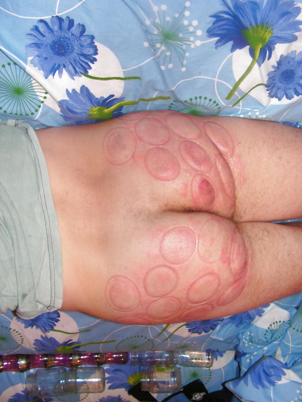 18P BDSM fire cups on ass