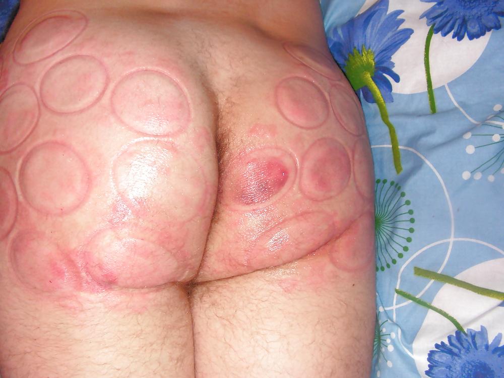 18P BDSM fire cups on ass