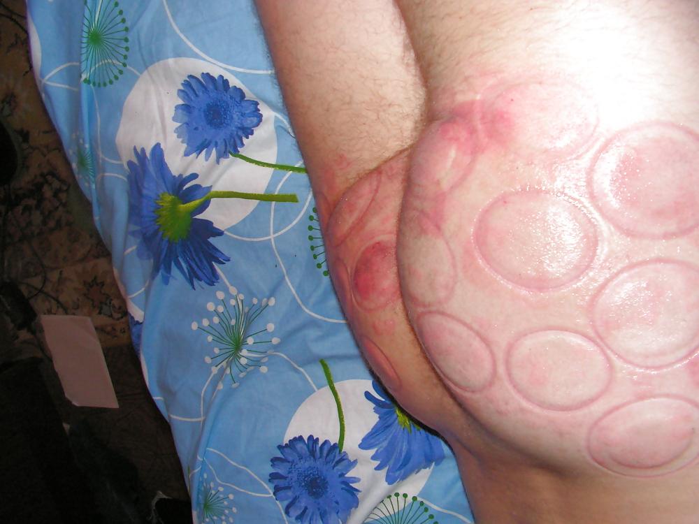18P BDSM fire cups on ass
