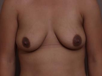 25P Saggy breast vol 30