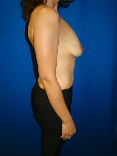 25P Saggy breast vol 30