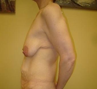 25P Saggy breast vol 27