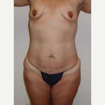25P Saggy breast vol 27