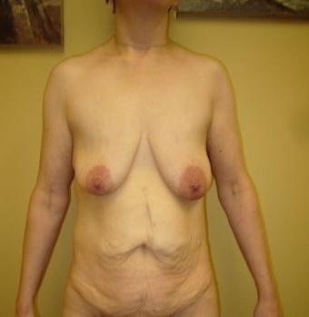25P Saggy breast vol 27