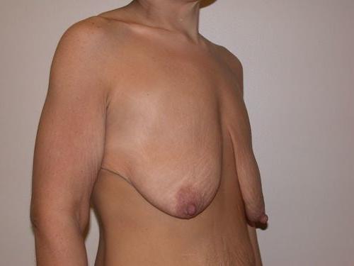 25P Saggy breast vol 27